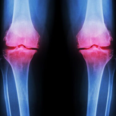 Osteo-Articular