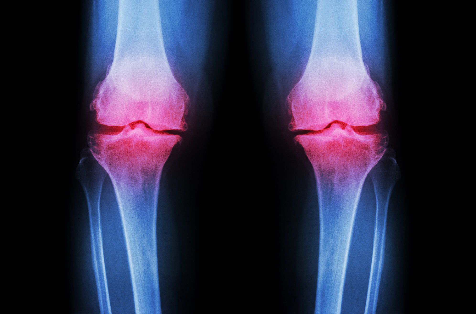 Osteo-Articular