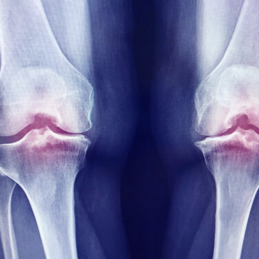 Osteo-Articular