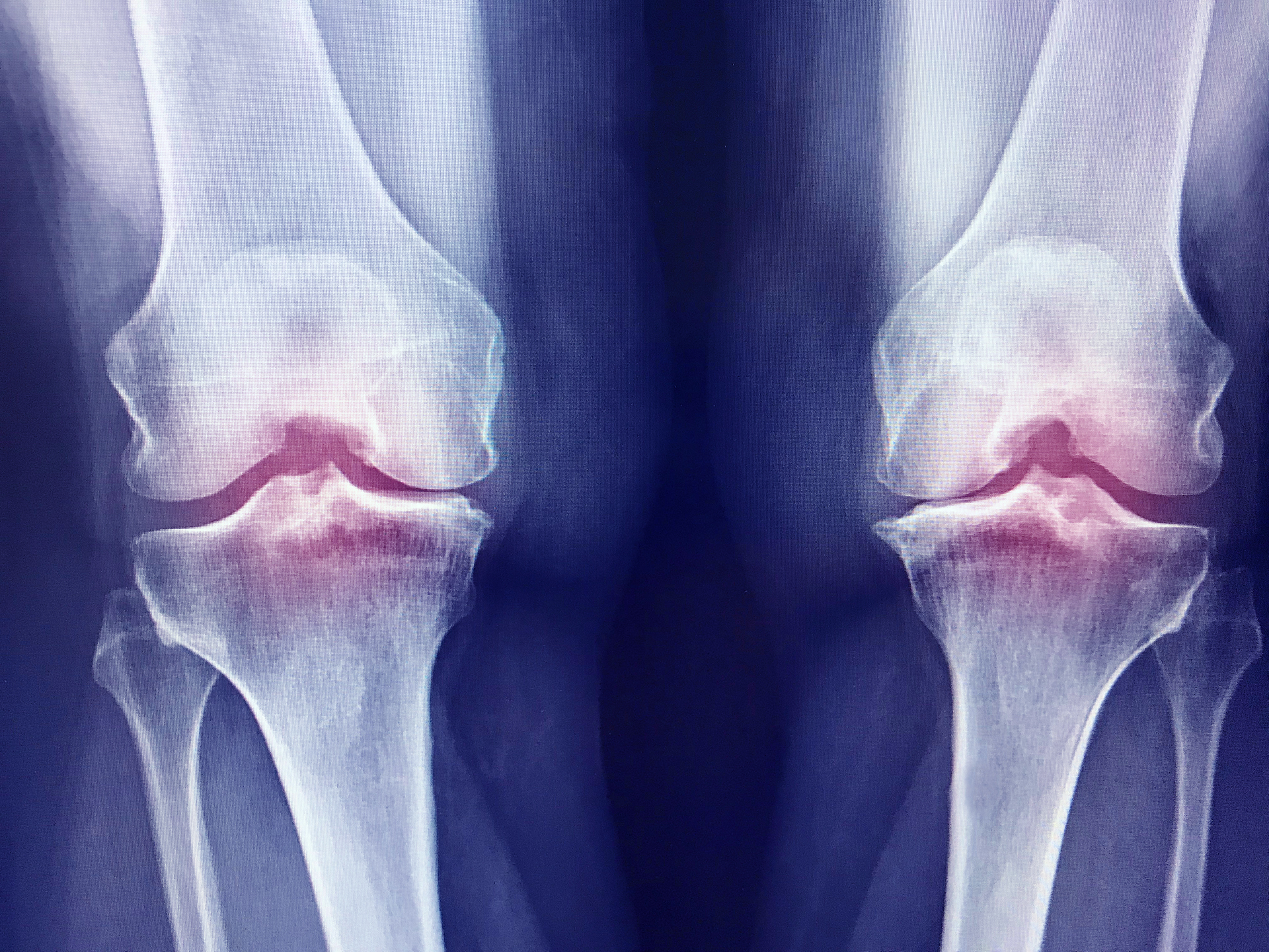 Osteo-Articular